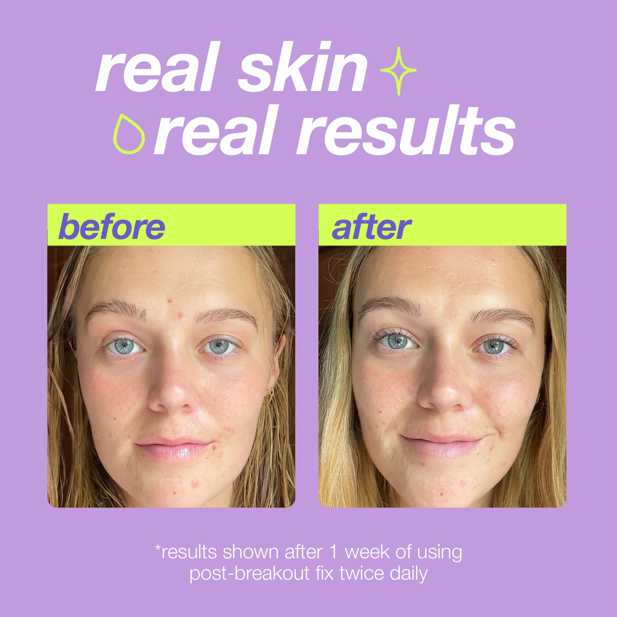 Dermalogica Post-Breakout Fix 15 ml 2