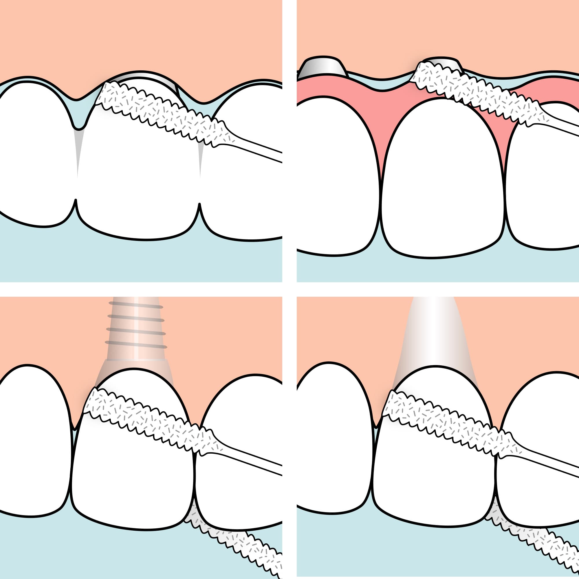 TePe Bridge & Implant Floss 30 st 3