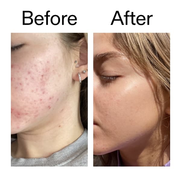 The INKEY List Beta Hydroxy Acid Serum 30 ml 4